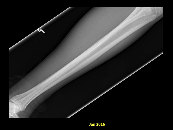 Figure 3 for case stress fracture ( RID4695 )